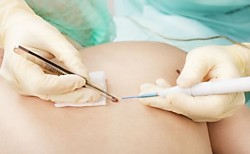 Удаление бородавок и кондилом